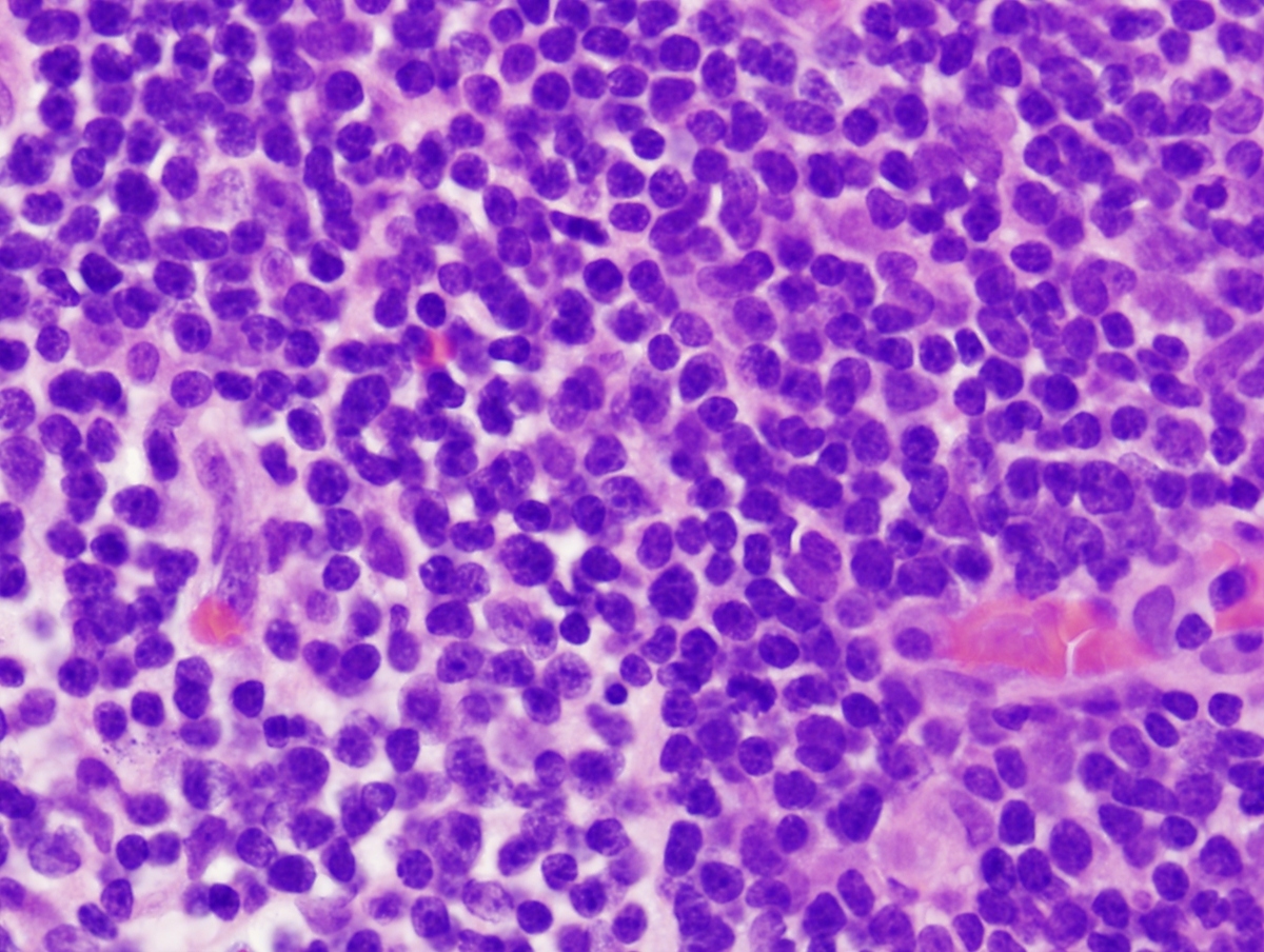 High power view of LN1 demonstrating lymphoblastic morphology of the cells (H&E, 40x).